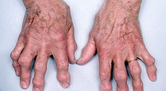 Картинка по теме - как лечить шишки на руках