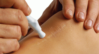 Картинка по теме - как убрать швы после операции