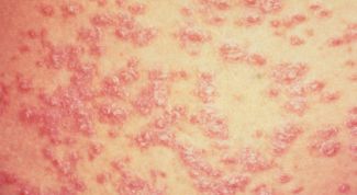 Картинка по теме - как излечиться от псориаза