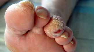 Картинка по теме - как лечить грибковую инфекцию