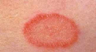 Картинка по теме - как избавиться от розового лишая