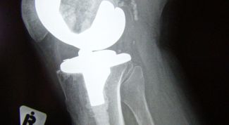 Картинка по теме - как вылечить полиартрит