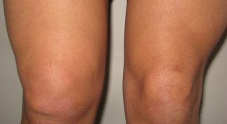 Картинка по теме - как убрать жидкость в колене