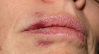 Картинка по теме - как избавиться от покраснения