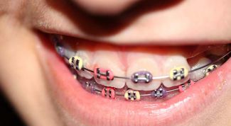 Картинка по теме - как исправить прикус зубов