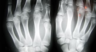 Картинка по теме - как лечить выбитый палец