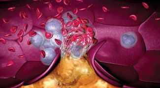 Картинка по теме - как лечить тромб