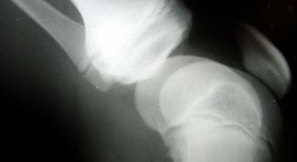 Картинка по теме - как лечить привычный вывих