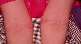 Картинка по теме - как лечить дерматоз