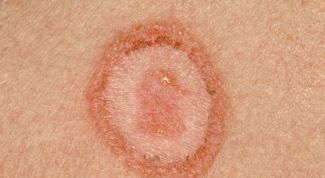 Картинка по теме - как лечить розовый лишай