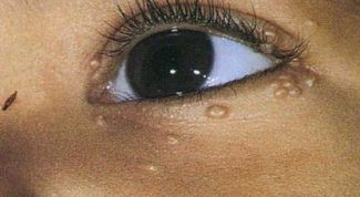 Картинка по теме - как удалить бородавки у ребенка