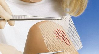 Картинка по теме - как лечить ожог на слизистой