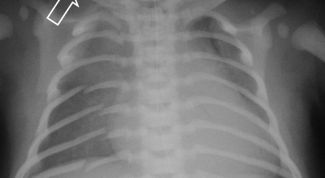 Картинка по теме - как узнать, сломано ли ребро