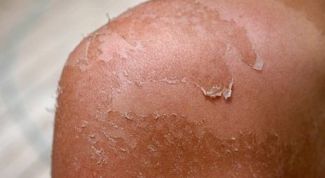 Картинка по теме - как лечить пузыри при ожогах