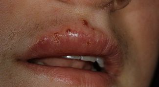 Картинка по теме - как лечить герпес