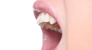 Картинка по теме - как исправить прикус взрослым