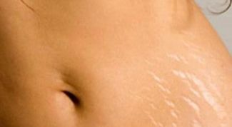 Картинка по теме - как избавиться от белых растяжек