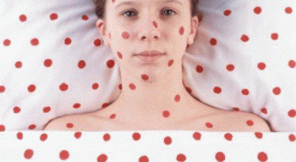 Картинка по теме - как обезопасить себя от ветрянки