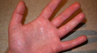 Картинка по теме - почему потеют руки