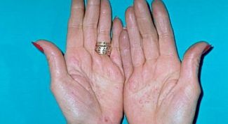 Картинка по теме - как избавиться от кожного клеща