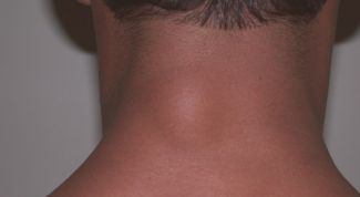 Картинка по теме - что такое липома