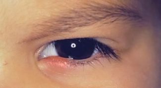 Картинка по теме - что делать при ячмене