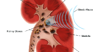 Картинка по теме - что делать, чтобы не было камней в почках
