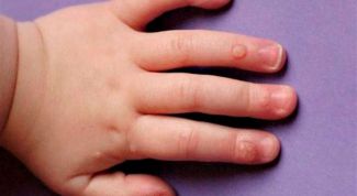 Картинка по теме - как лечить бородавки у детей