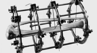 Картинка по теме - как снять аппарат елизарова