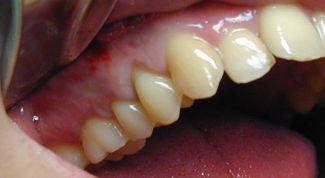 Картинка по теме - что делать, если опухла десна