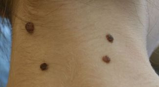 Картинка по теме - что делать, если содрал родинку