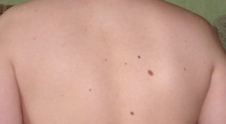 Картинка по теме - почему появляются новые родинки 