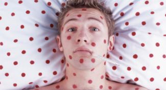Картинка по теме - как обнаружить симптомы ветрянки