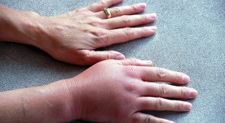 Картинка по теме - почему отекают руки