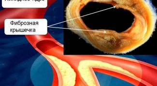 Картинка по теме - что такое атеросклероз сосудов