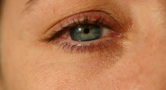 Картинка по теме - что делать, если гноятся глаза