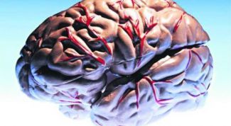 Картинка по теме - что такое инсульт мозга