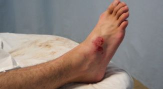 Картинка по теме - лечение гематомы народными средствами