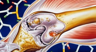 Картинка по теме - как проводить лечение артроза