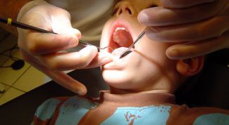 Картинка по теме - как определить кариес