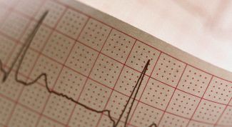 Картинка по теме - что такое синусовая аритмия