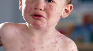Картинка по теме - как выявить ветрянку по основным симптомам
