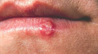 Картинка по теме - как выявить герпес