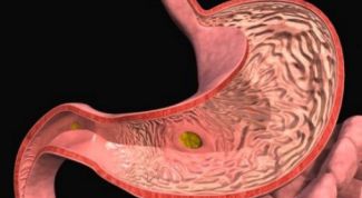 Картинка по теме - как сделать эффективным лечение гастрита
