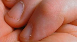 Картинка по теме - как лечить заусенцы