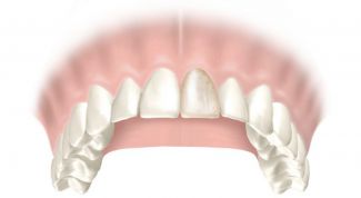 Картинка по теме - как отбелить коронку