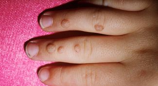 Картинка по теме - как избавиться от бородавки у ребенка