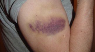 Картинка по теме - как лечить растяжения и ушибы