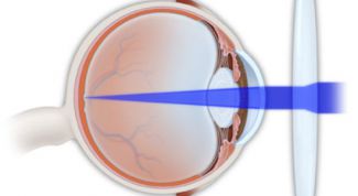 Картинка по теме - как исправить астигматизм