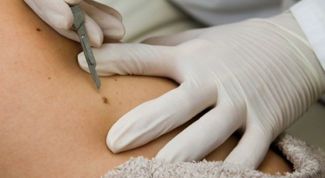 Картинка по теме - как вылечить воспаленную родинку